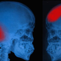 An xray image of the skull with areas of injury highlighted in red